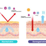 Moist Wound Healing vs. Dry Wound Healing