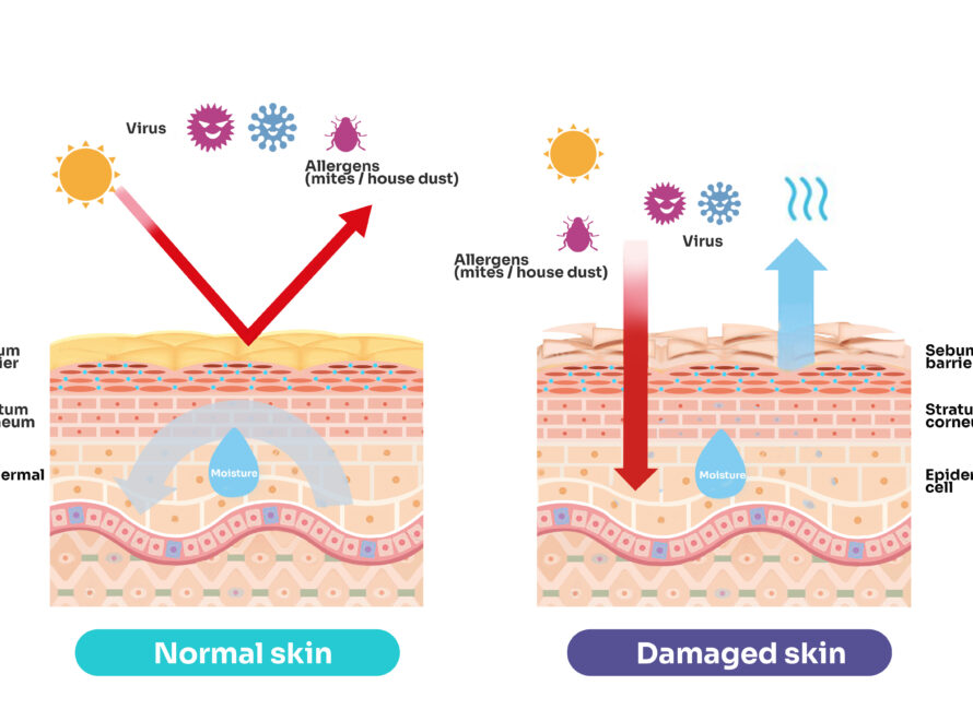 Moist Wound Healing vs. Dry Wound Healing