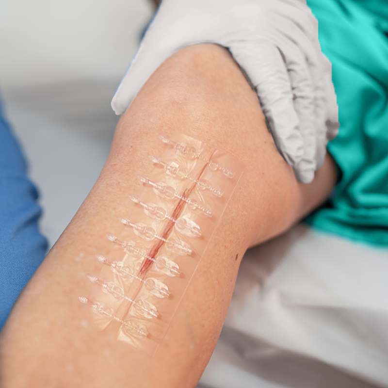 Surgical Incision Closure Set skin stapler enabling fast and efficient wound closure in surgical procedures