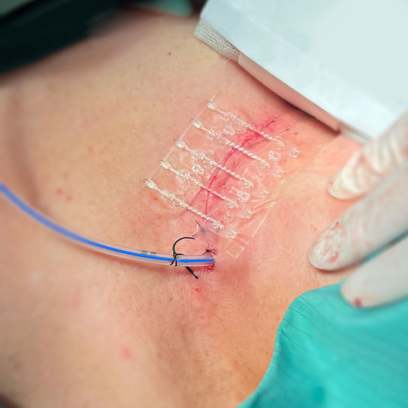 Minimally invasive Surgical Incision Closure Set reducing skin trauma and post-surgical scarring