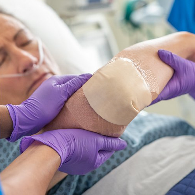 Soft silicone adhesive foam dressing ensuring painless removal and enhanced comfort for patients