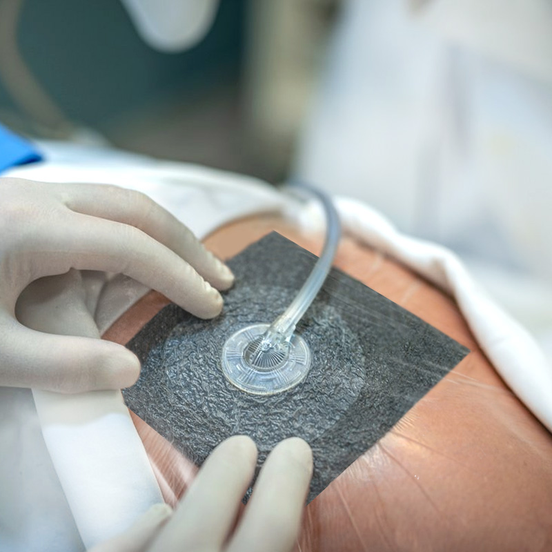 V.A.C. Dressing in place on wound site with arrows showing improved circulation and healing