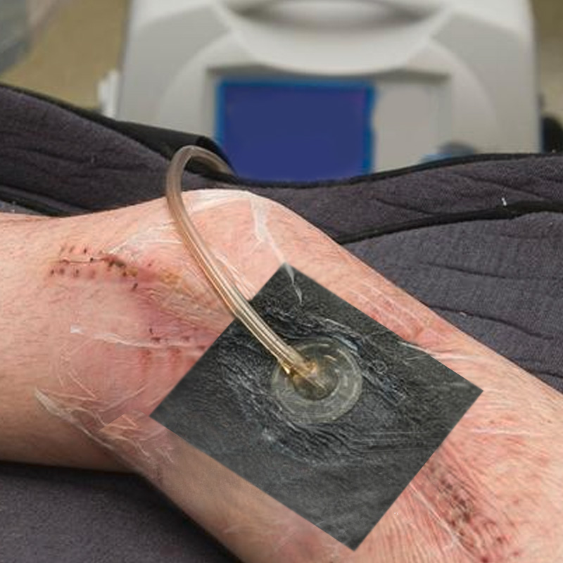 Diagram showing exudate being drawn away through V.A.C. foam dressing and tube