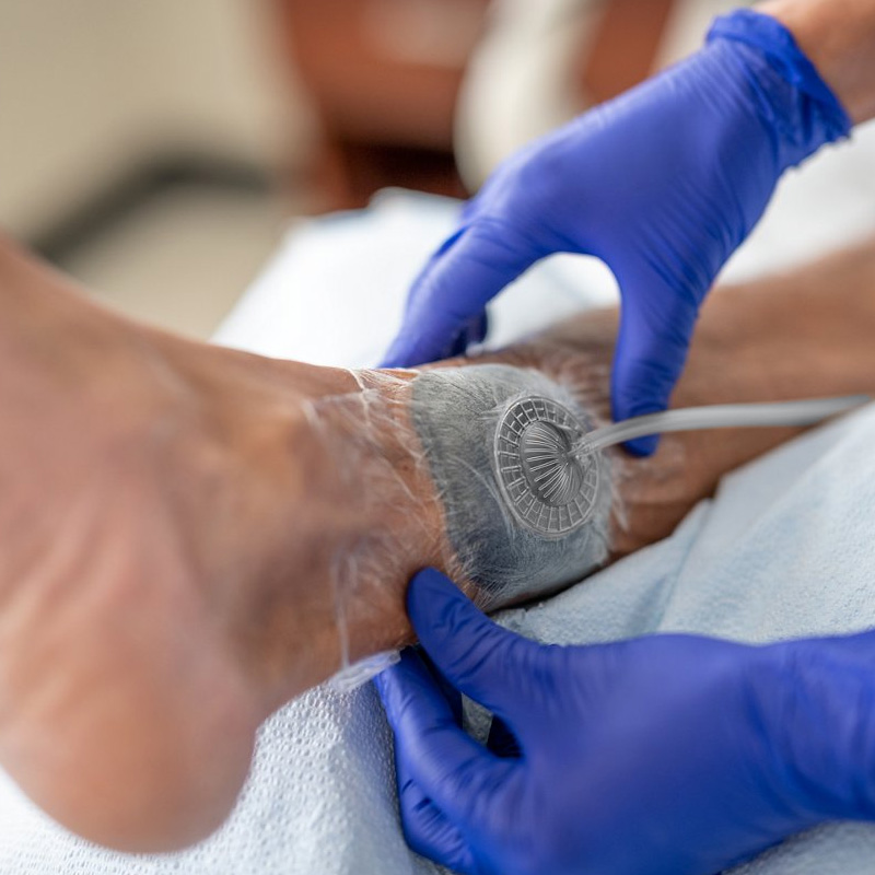 V.A.C. Dressing Kit conforming to uneven wound area with sealing drape