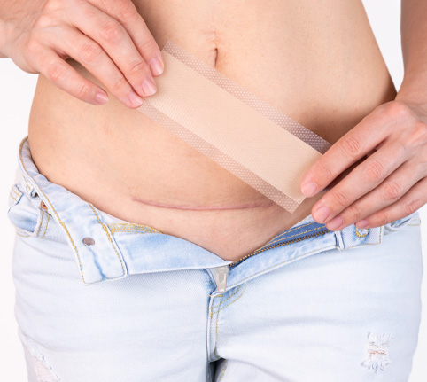 Silicone scar sheet applied on arm for scar treatment