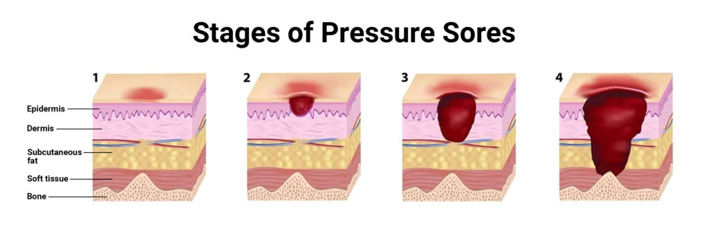 Pressure ulcer stages diagram showing stage 1 to stage 4