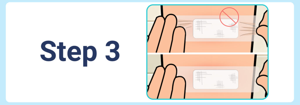 Applying medical tape evenly without stretching