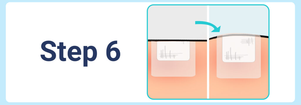 Loosening medical tape if swelling occurs