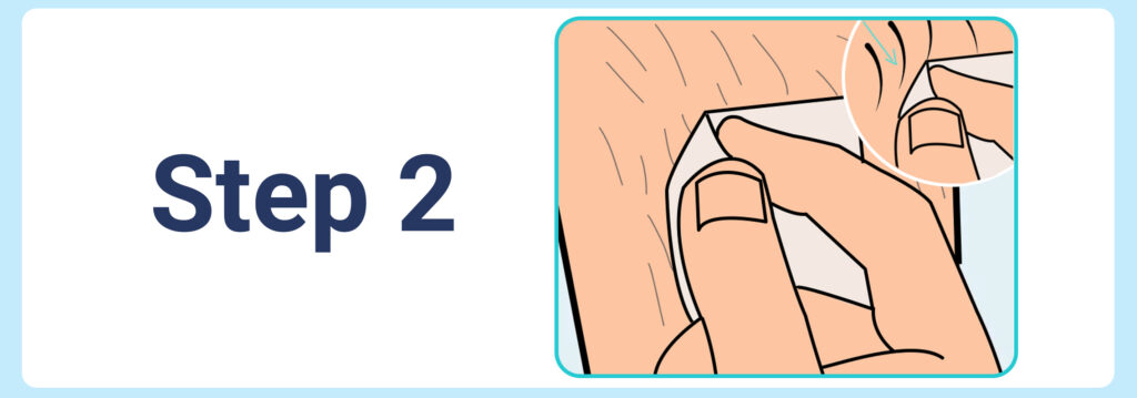 Removing medical tape slowly in the direction of hair growth