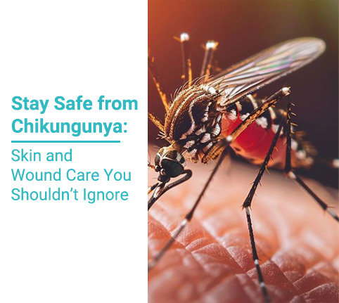 Protect your skin during Chikungunya outbreaks with proper wound care