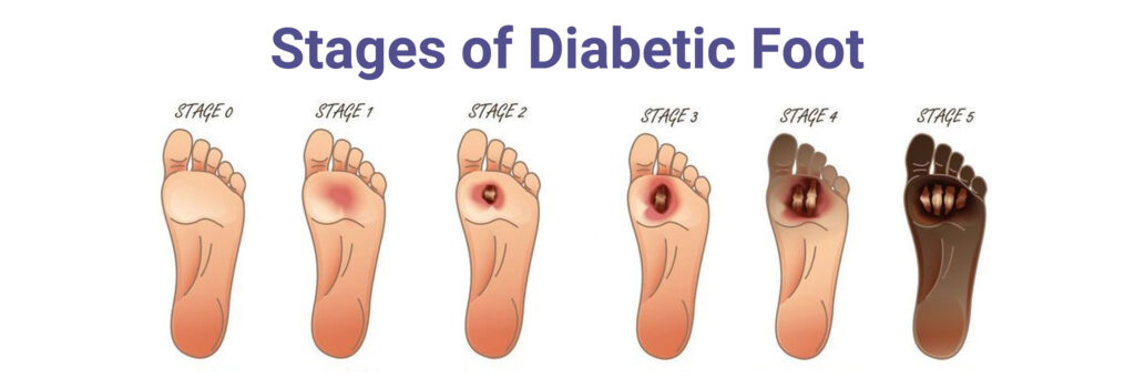 Visual chart showing the stages of diabetic foot ulcers, from early redness and callus to open wound and infection, with corresponding wound care treatments.