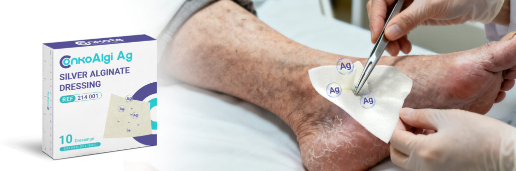 Silver alginate dressing ConkoAlgi Ag shown absorbing wound exudate and releasing silver ions for antibacterial protection and moist healing.