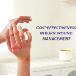 Clinical selection of advanced burn dressings based on wound condition and healing needs
