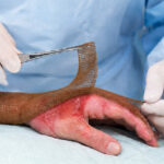 Healthcare professional assessing a burn wound and selecting an appropriate dressing to support healing and wound management.