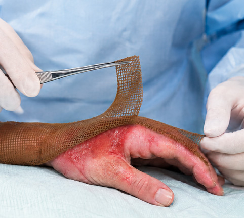 Healthcare professional assessing a burn wound and selecting an appropriate dressing to support healing and wound management.