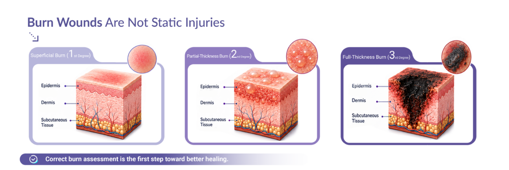 Comparison of superficial, partial-thickness, and full-thickness burn injuries