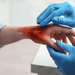 Illustration showing different levels of burn wound severity from superficial skin injury to deep tissue damage.