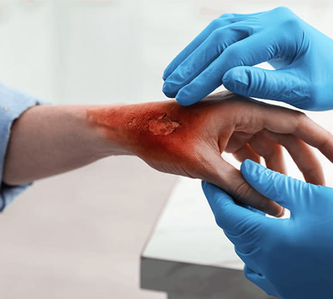 Illustration showing different levels of burn wound severity from superficial skin injury to deep tissue damage.