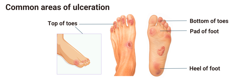 Common Locations of Diabetic Foot Ulcers