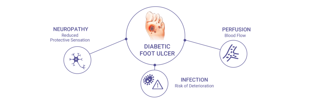 Diabetic foot ulcer assessment diagram highlighting neuropathy, perfusion, and infection risk